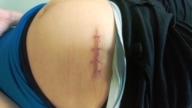 apendix-scar